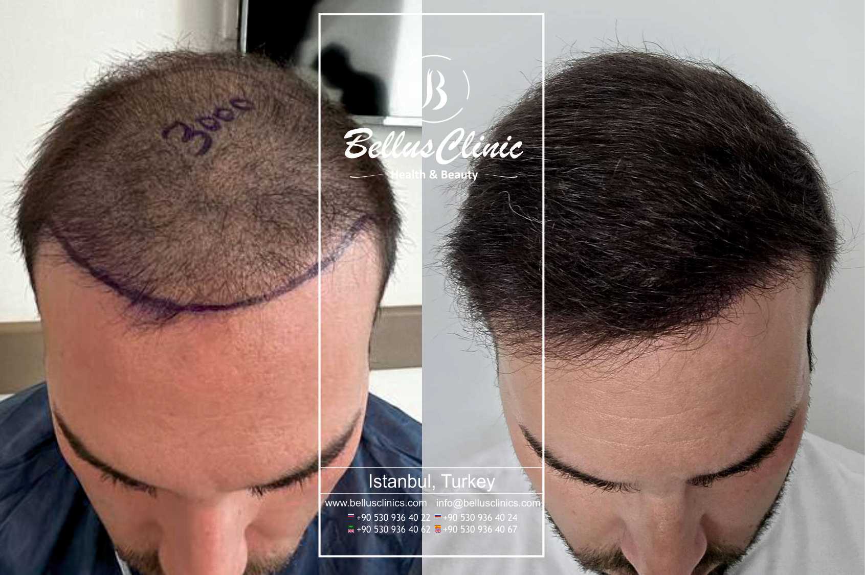 باقة زراعة الشعر بتقنية DHI من عيادة Bellus