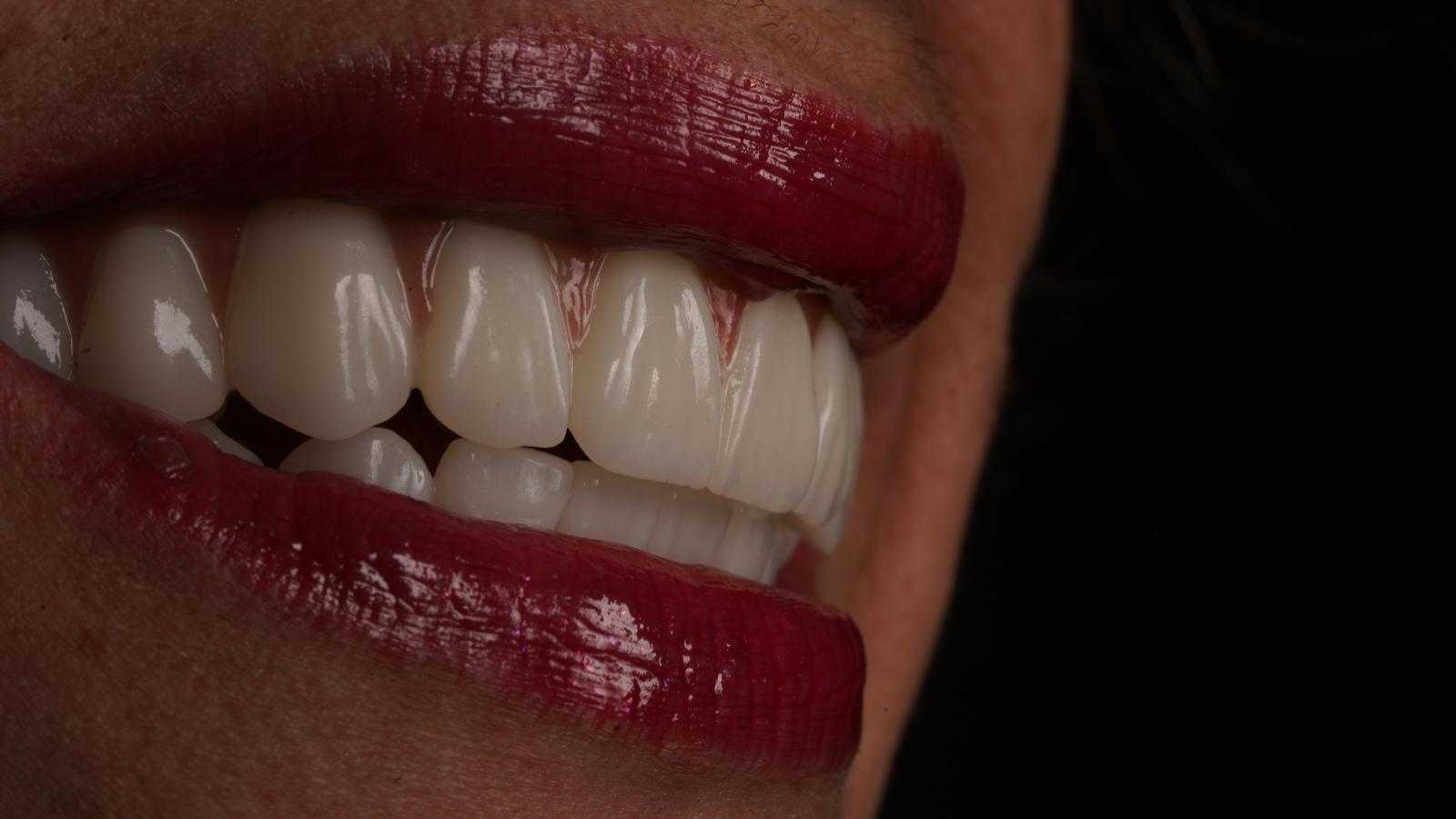 باقة تجميل الابتسامة في عيادة برايم إسطنبول، تركيا