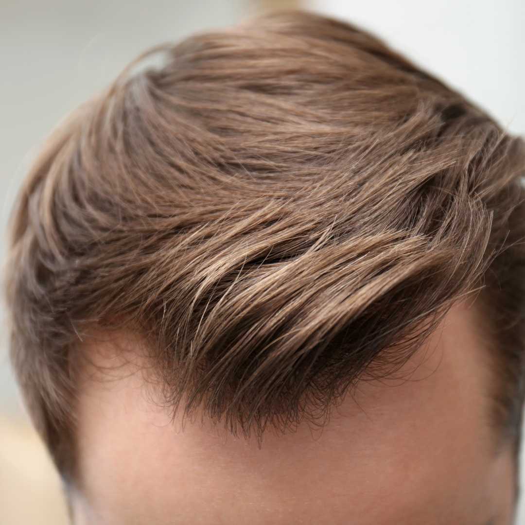 زراعة الشعر بتقنية FUE في عيادة بيلوس - استرجع شعرك مع عيادة بيلوس