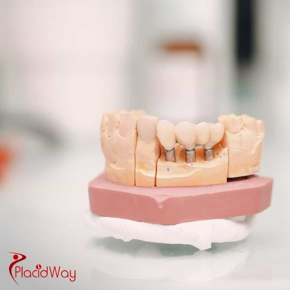 كم تكلفة زراعة الأسنان All on 4 في تايلاند في عام 2025؟