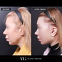 باقة شد الرقبة في سيول، كوريا الجنوبية، بواسطة VG Plastic Surgery thumbnail