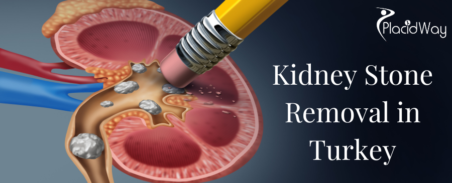 جراحة إزالة حصوات الكلى في تركيا