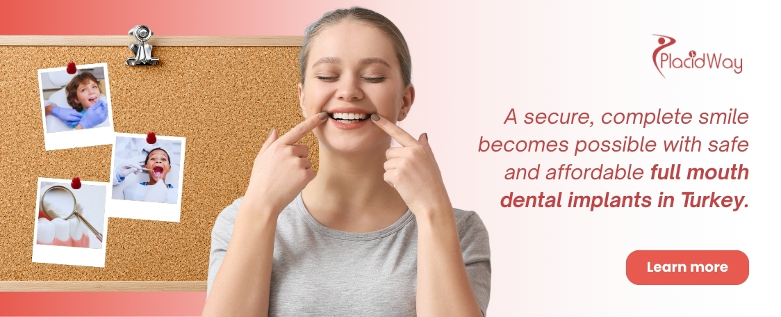 زراعة الأسنان الكاملة في تركيا - بأسعار معقولة وآمنة